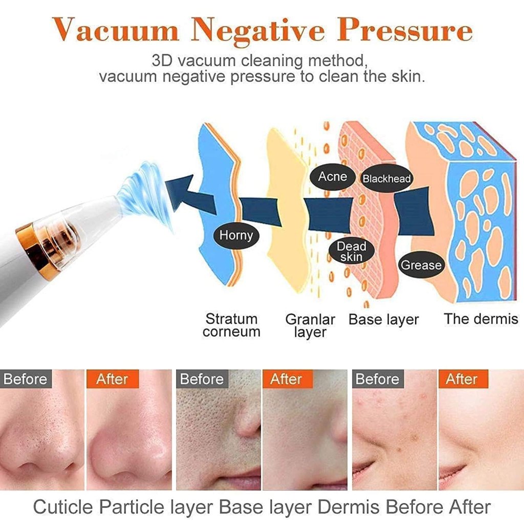 6-in-1 Electric Blackhead Remover with Vacuum Suction